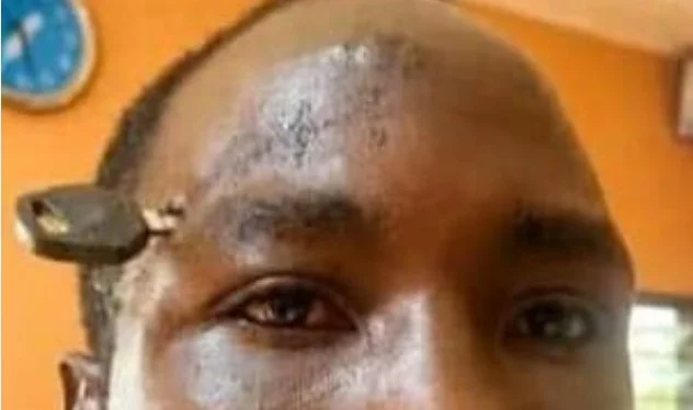 Doctors successfully remove motorbike key from skull of farmer who was stabbed during an attempt to stop a fight